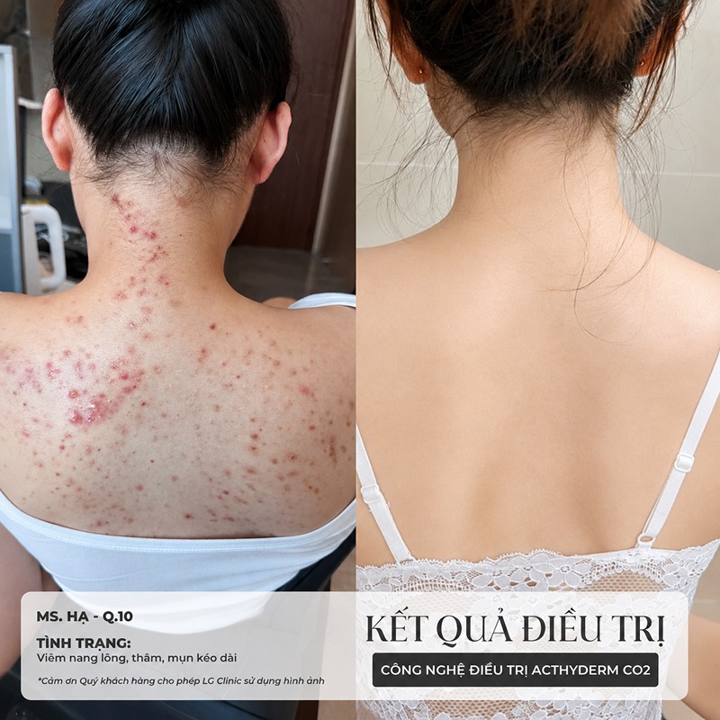 spa trị mụn lưng vũng tàu