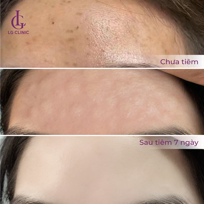 giảm thâm vùng trán sau khi tiêm mesotherapy