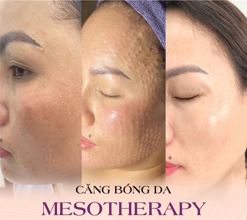 Da căng bóng sau khi tiêm mesotherapy
