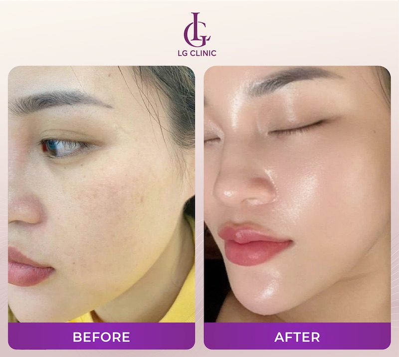 tiêm mesotherapy giúp da căng bóng hơn