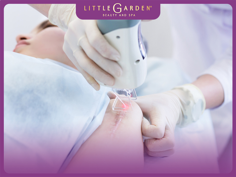 điều trị sẹo rỗ bằng Laser Fractional CO2