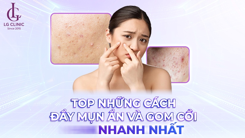 Cách đẩy nhân mụn ẩn lên nhanh
