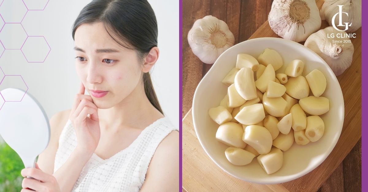cach-tri-mun-an-tai-nha-voi-toi-cho-lan-da-cang-bong Cách trị mụn ẩn tại nhà với tỏi cho làn da căng bóng
