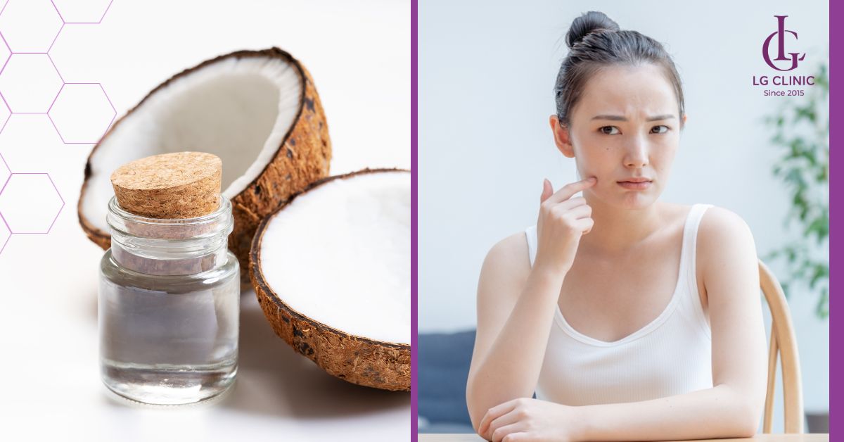 dau-dua-ho-tro-dieu-tri-mun-an-hieu-qua Dầu dừa hỗ trợ điều trị mụn ẩn hiệu quả