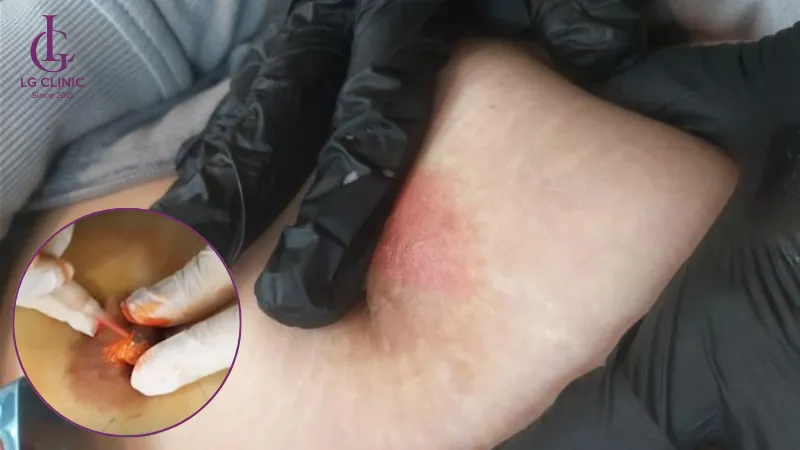 dịch vụ làm hồng nhũ hoa