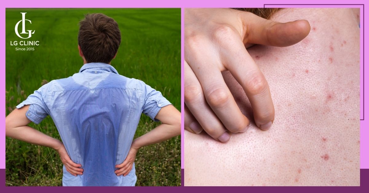 do-mo-hoi-nhieu-la-nguyen-nhan-gay-ra-mun-lung-o-nam Vì sao nam giới bị mụn lưng?