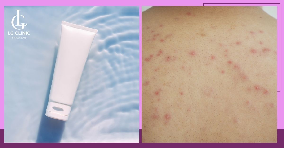 dung-lotion-duong-am-da-va-tri-mun-lung-hieu-qua Dùng Lotion dưỡng ẩm da và trị mụn lưng hiệu quả