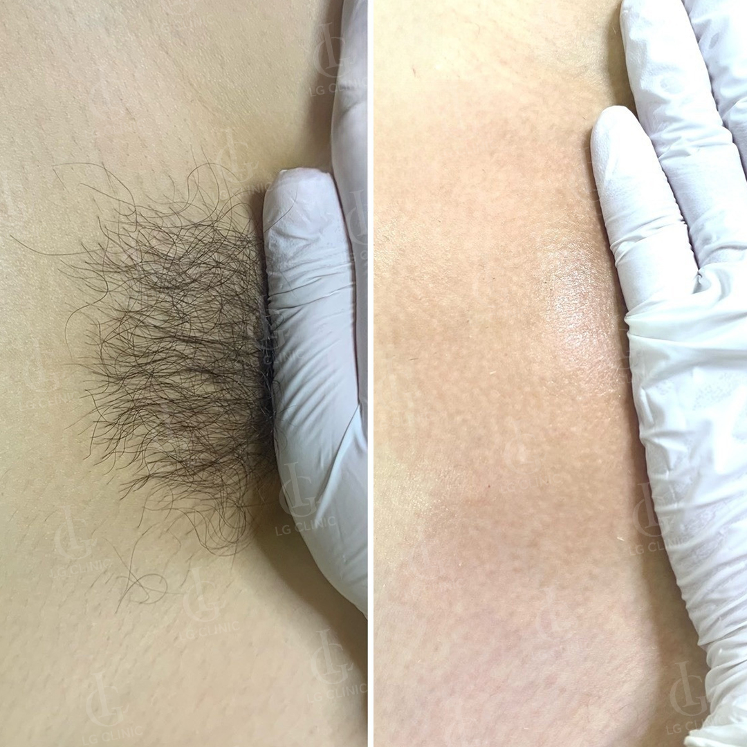 Hình ảnh trước và sau khi triệt lông bikini da sạch mịn