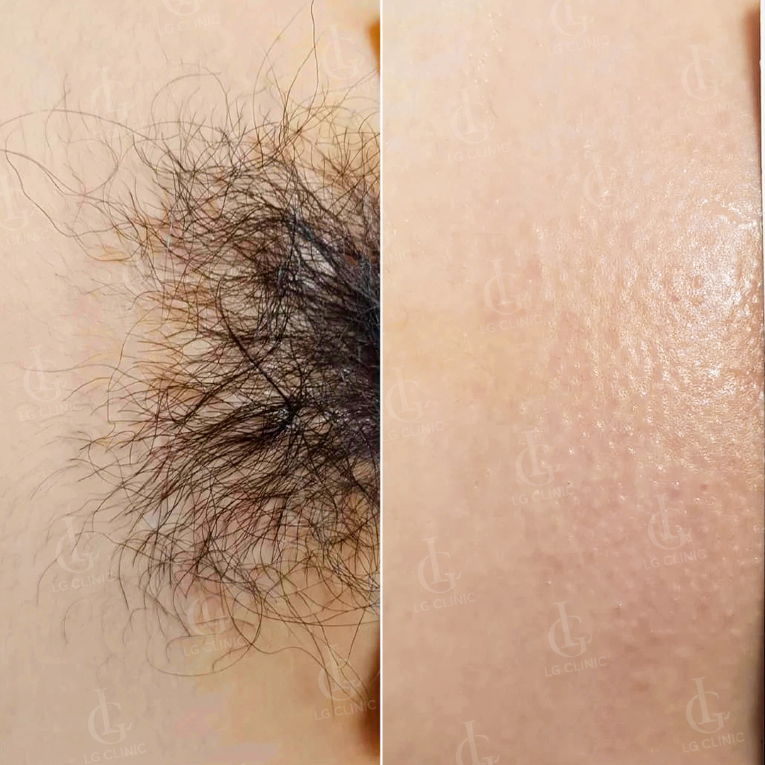 Hình ảnh sau khi triệt lông vùng kín nữ với tình trạng rậm rạp