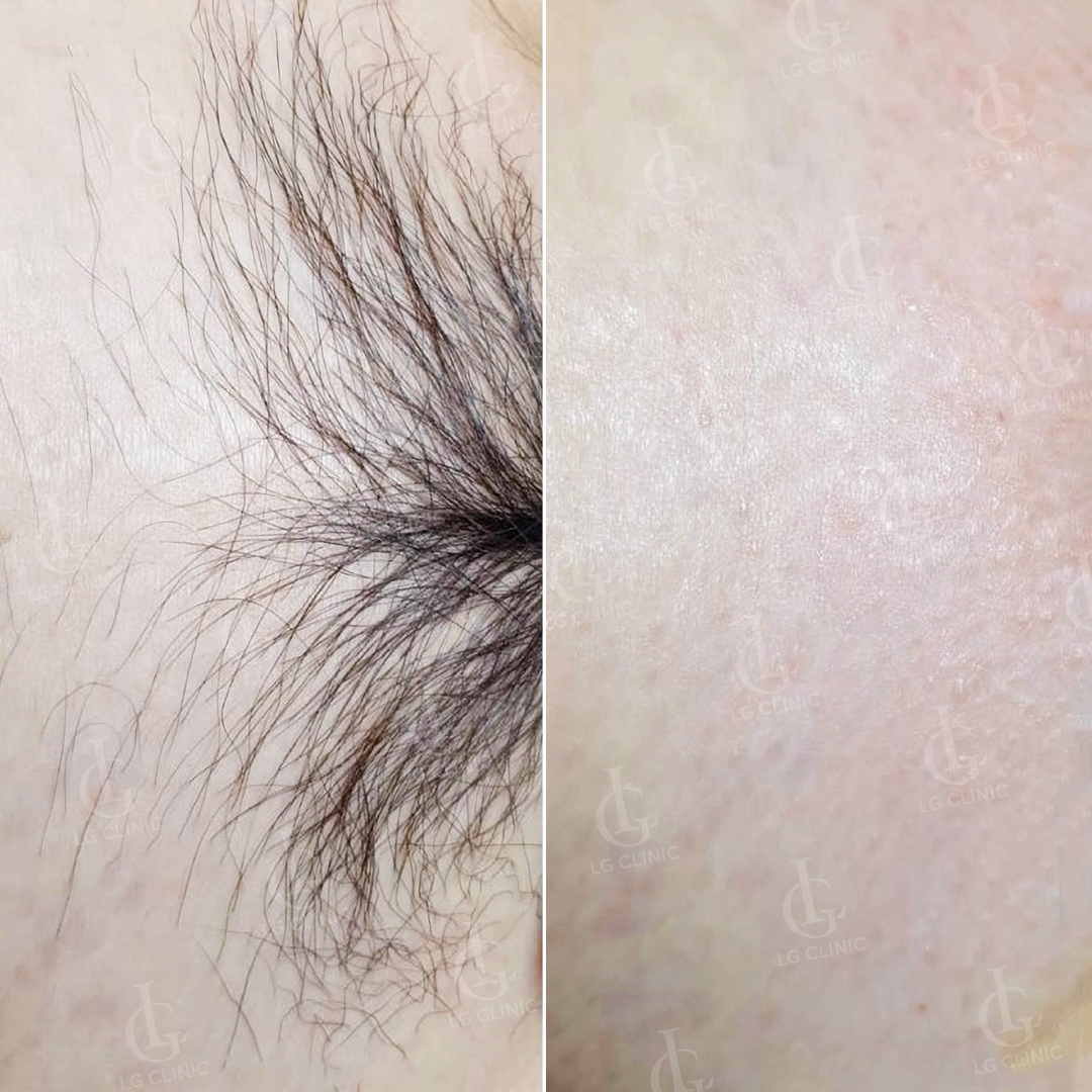 Sau khi triệt lông bikini sợi đen dài 