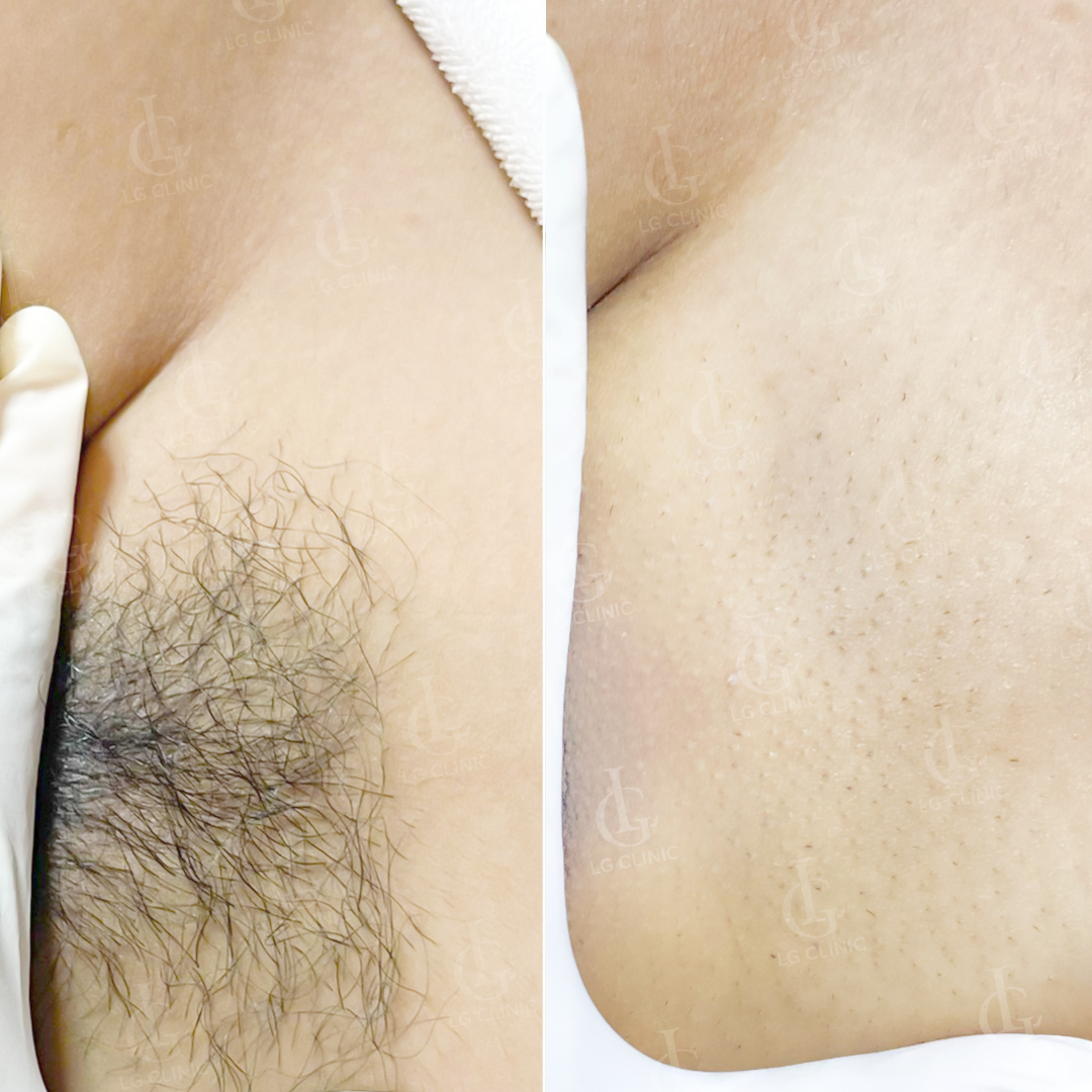 Kết quả sau khi triệt lông vùng kín sợi cứng xoăn