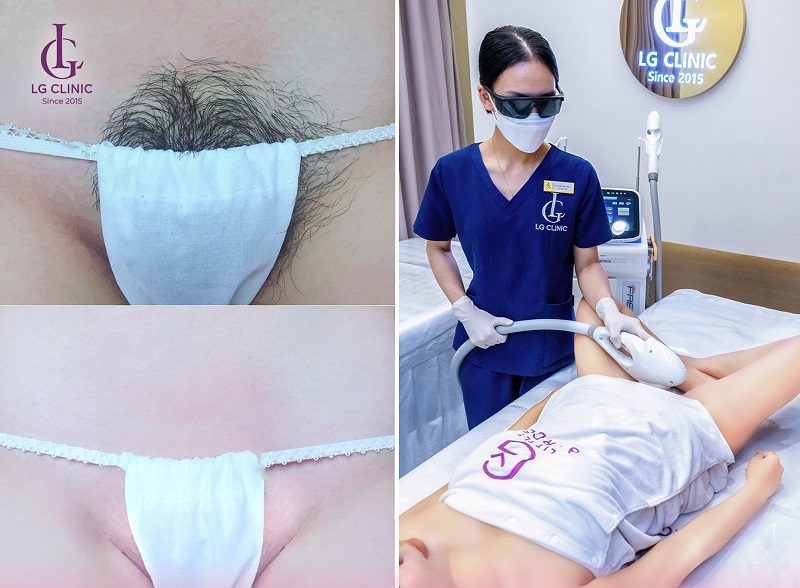 Quy trình triệt lông bikini tại LG Clinic