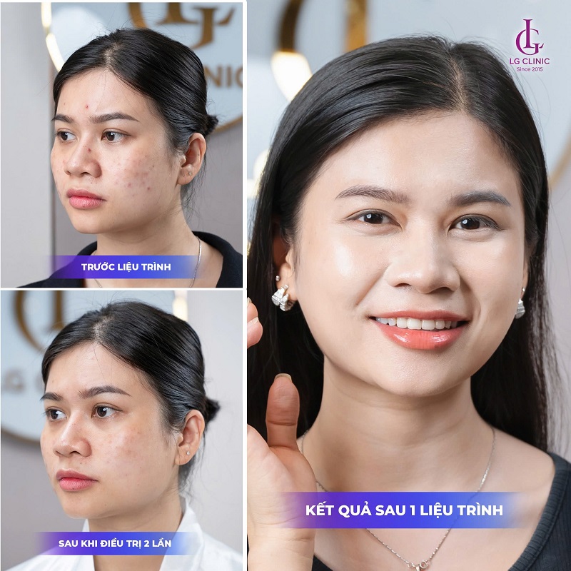 kết quả sau một liệu trình trị mụn tại LG Clinic