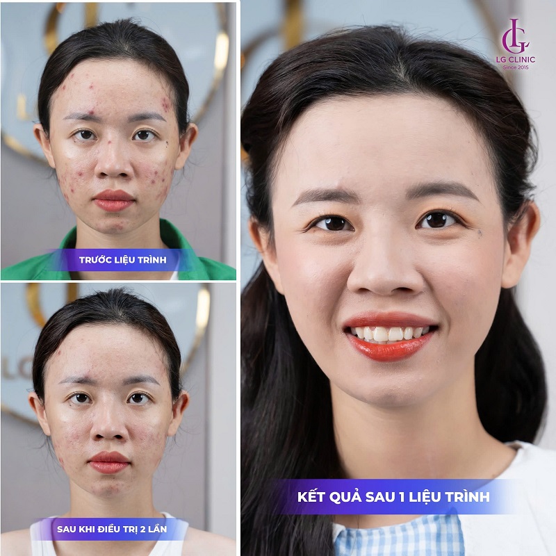 kết quả sau một liệu trình trị mụn tại LG Clinic