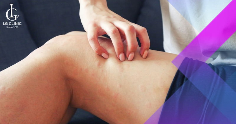 Không gãi lên khu vực da đang nổi mẩn đỏ