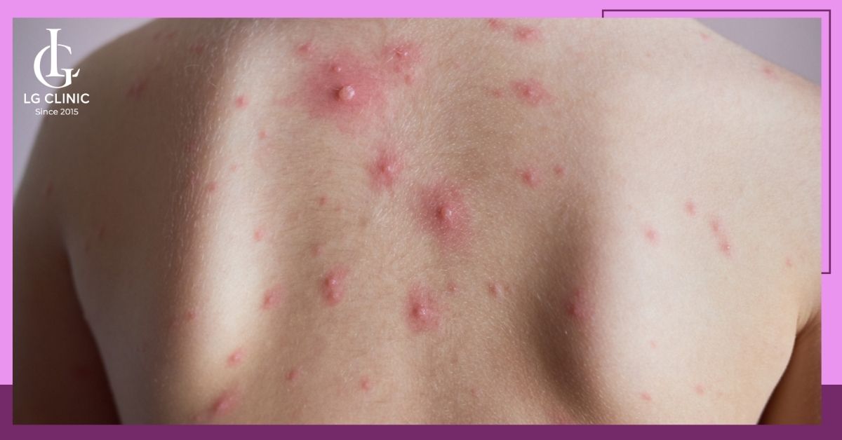 kien-tri-tri-mun-lung-de-dat-duoc-hieu-qua-tot-nhat Kiên trì trị mụn lưng để đạt được hiệu quả tốt nhất