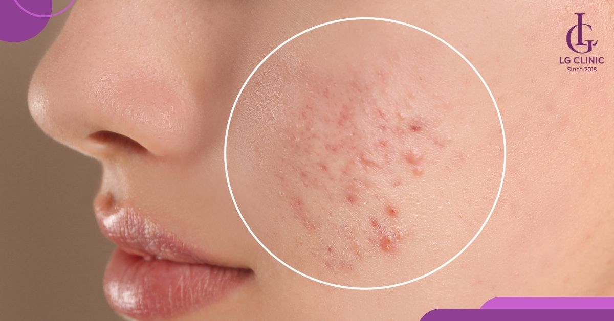 lay-nhan-mun-an-khi-mun-da-kho-coi Lấy nhân mụn ẩn khi mụn đã khô cồi