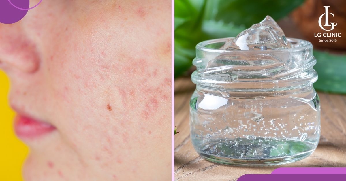 loai-bo-nhan-mun-an-bang-nha-dam Loại bỏ nhân mụn ẩn bằng nha đam