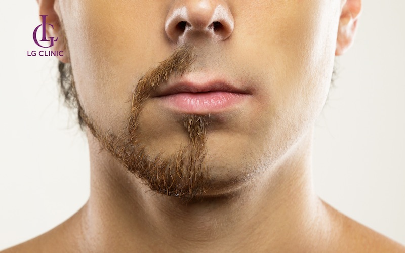 những lợi ích khi thực hiện triệt râu tại nhà