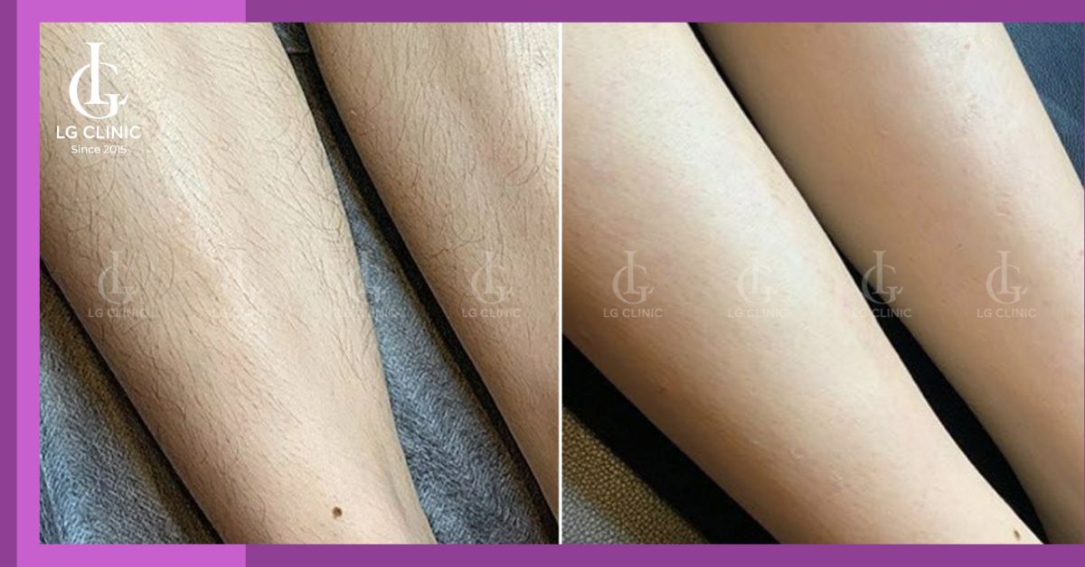 long-chan-duoc-don-dep-sach-se-qua-qua-trinh-triet-long Lông chân được dọn dẹp sạch sẽ qua quá trình triệt lông
