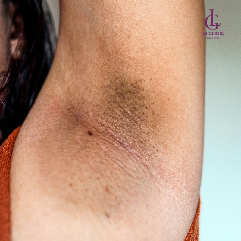 triệt lông nách có được dùng lăn khử mùi không