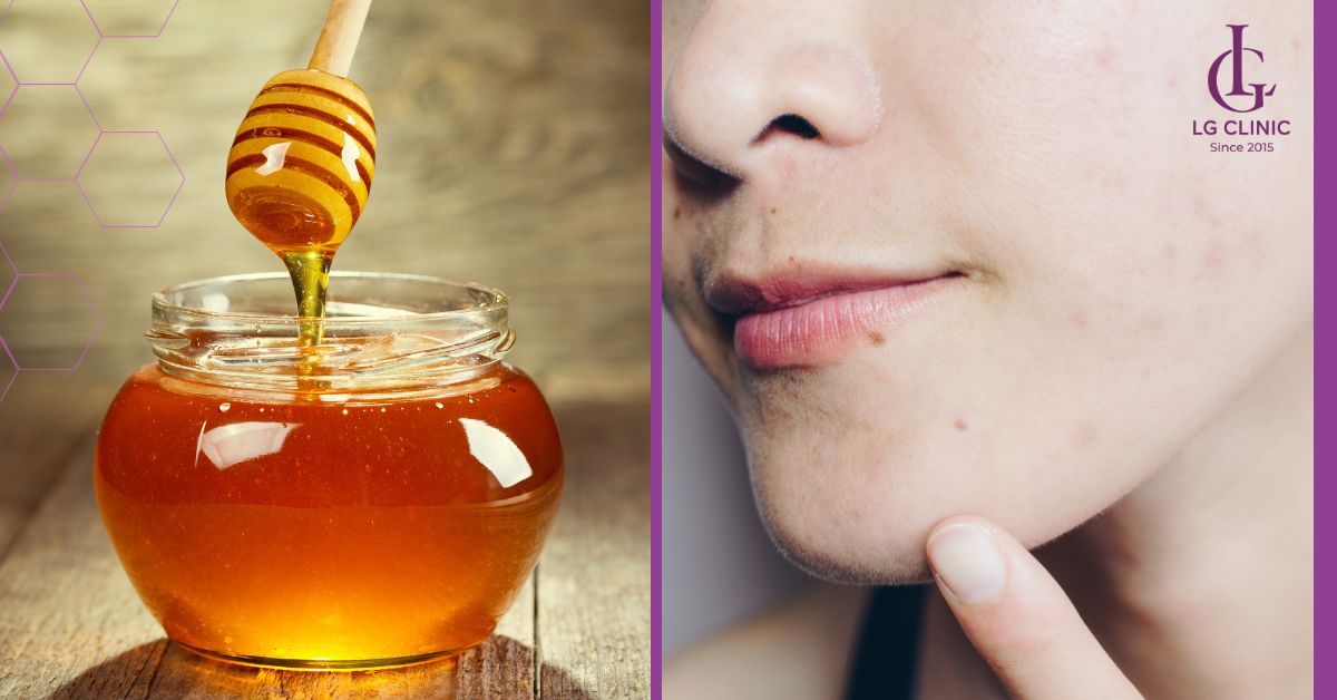 mat-ong-tri-mun-an-hieu-qua Mật ong trị mụn ẩn hiệu quả