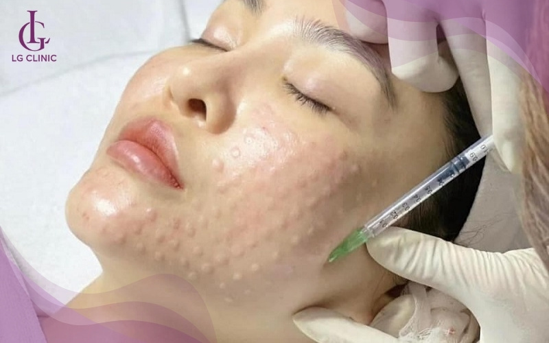 Mesotherapy là phương pháp thẩm mỹ tiêm dưỡng chất trực tiếp vào da