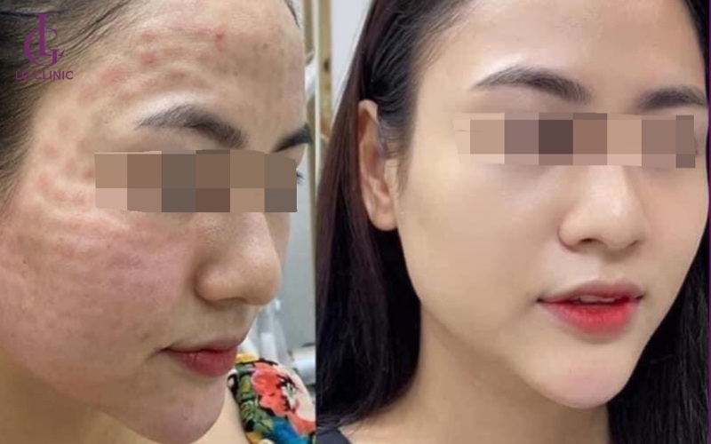Da săn chắc và căng bóng sau khi thực hiện tiêm meso