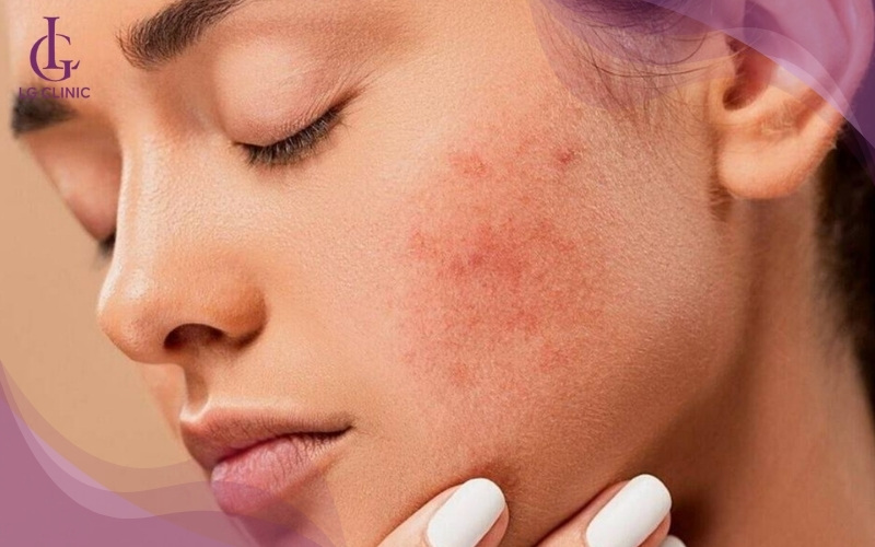 Vùng da điều trị bị viêm nhiễm không được thực hiện tiêm meso