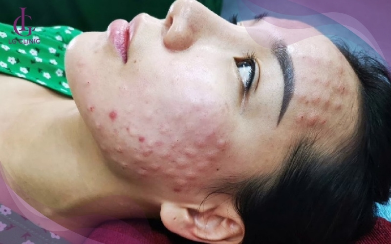 Sau khi thực hiện Mesotherapy có thể sưng bầm nhẹ ở vị trí tiêm