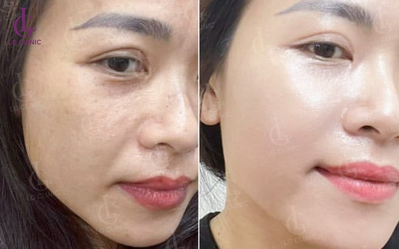 Đánh bay nếp nhăn do tuổi tác với Meso Exo Plus