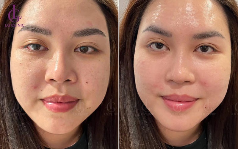 Lấy lại diện mạo trẻ trung bằng liệu pháp Mesotherapy