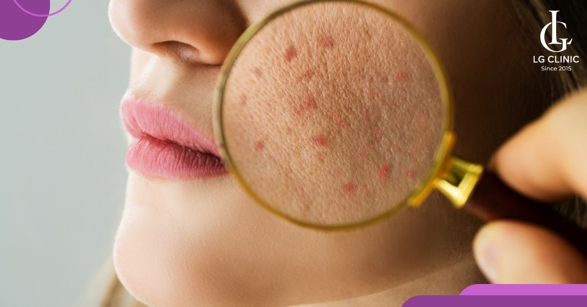 mun-an-co-kich-thuoc-nho-va-kho-nhan-biet Mụn ẩn có kích thước nhỏ và khó nhận biết