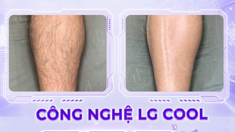 Chân sáng mịn, sạch lông sau liệu trình triệt lông LG Cool