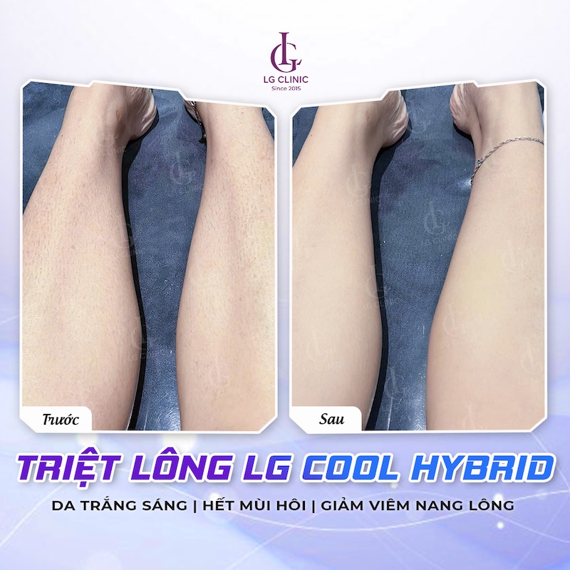 Hình ảnh trước và sau buổi đầu triệt lông tại LG Clinic