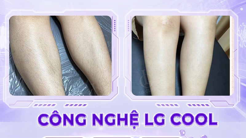 Hình ảnh trước và sau buổi đầu triệt lông tại LG Clinic