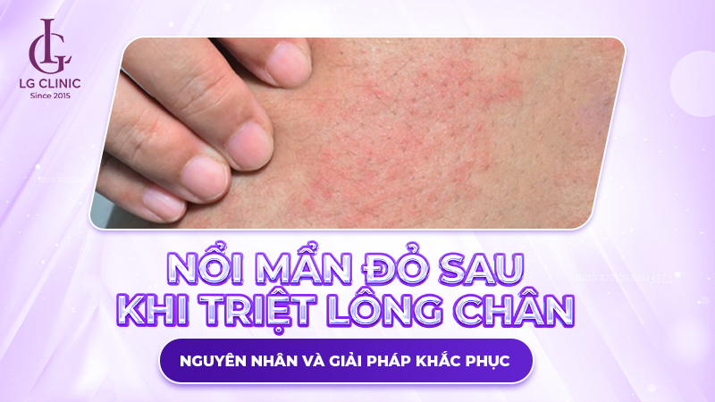 Nổi mẩn đỏ sau khi triệt lông chân