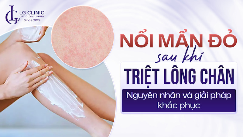 nổi mẫn đỏ sau khi triệt lông chân