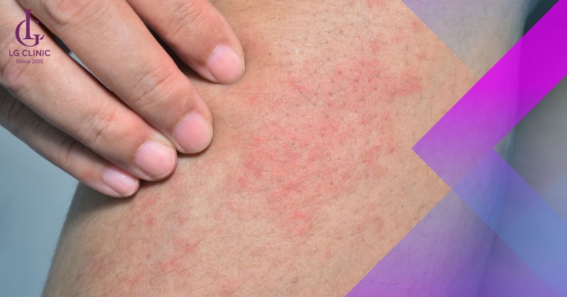 Nổi mẩn đỏ sau khi triệt lông chân có thể do cơ địa