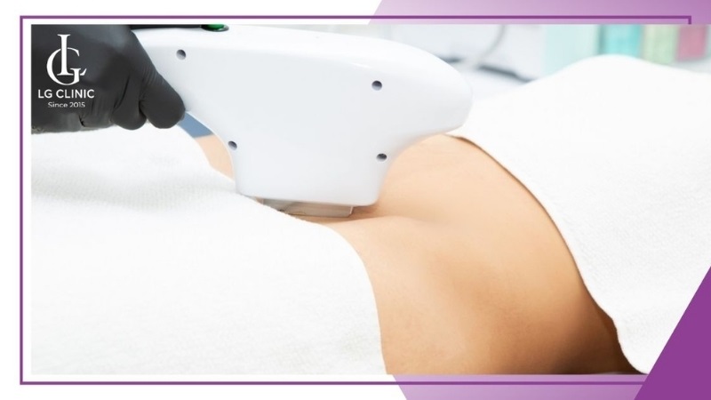 Triệt lông tạo hình bikini phong thủy được ưa chuộng và trở thành trào lưu