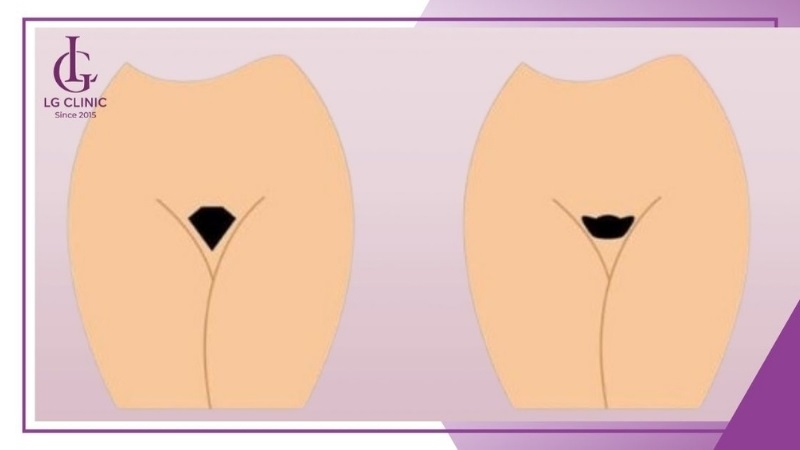 Người mệnh Kim hợp với dáng bikini hình kim cương, hình vàng thỏi