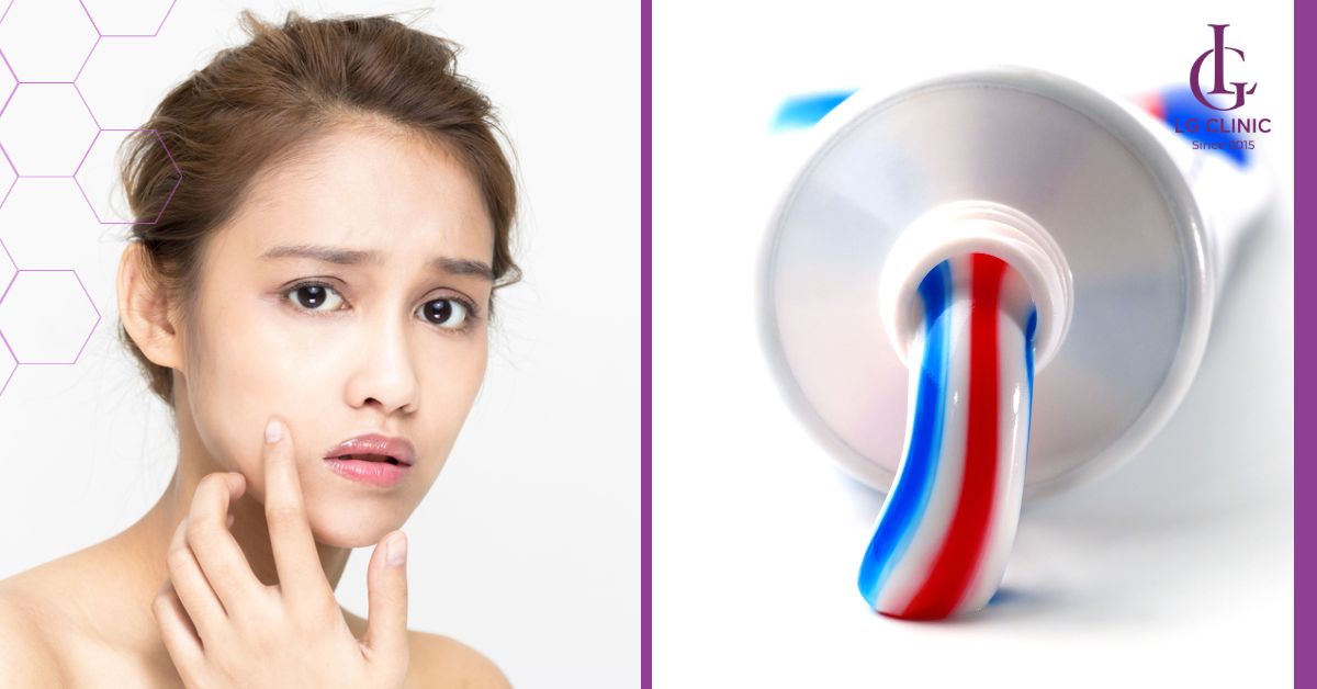 tri-mun-an-bang-kem-danh-rang Trị mụn ẩn bằng kem đánh răng