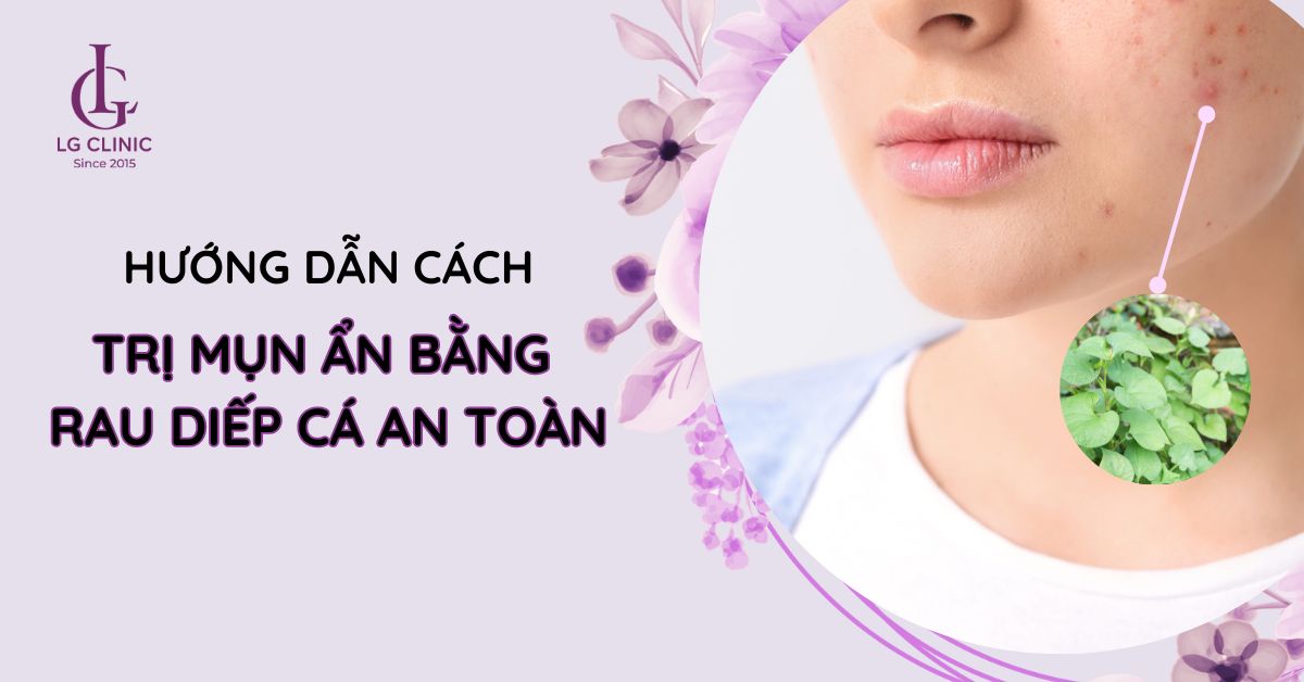trị mụn ẩn bằng rau diếp cá