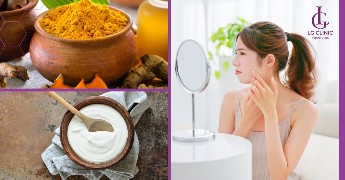 tri-mun-an-voi-hon-hop-nghe-va-sua-chua Trị mụn ẩn với hỗn hợp nghệ và sữa chua