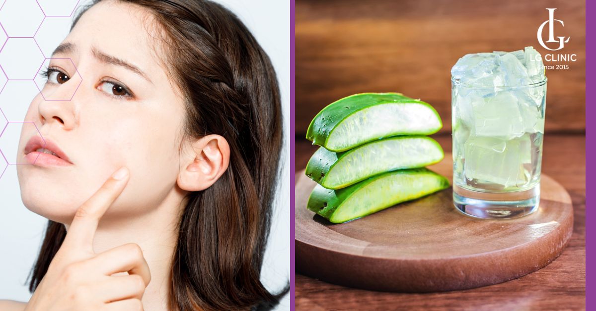 tri-mun-an-voi-nha-dam Trị mụn ẩn với nha đam