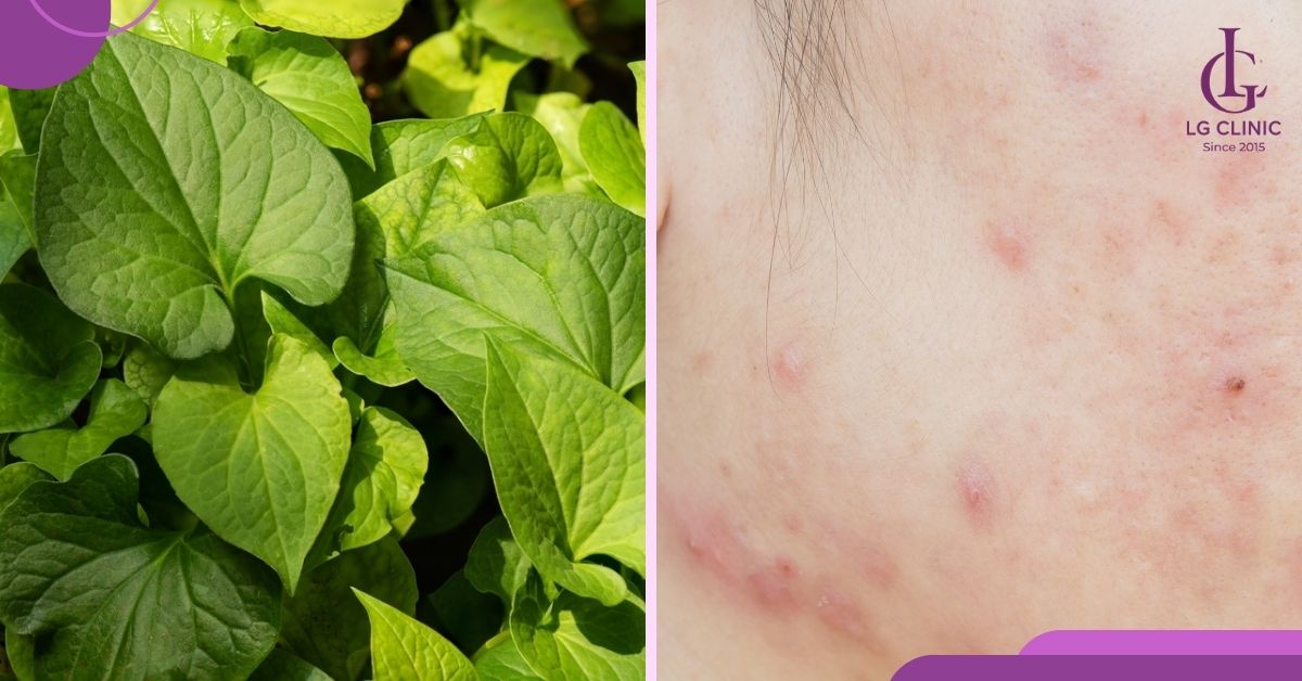 tri-van-de-mun-an-voi-rau-diep-ca Trị vấn đề mụn ẩn với rau diếp cá