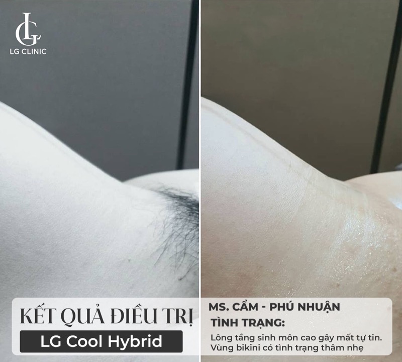 kết quả triệt lông