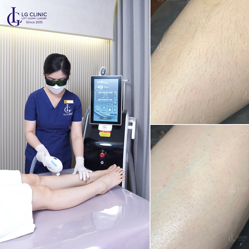triệt lông chân bị nổi mẫn đỏ