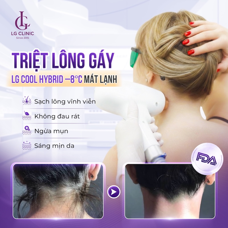 triệt lông gáy