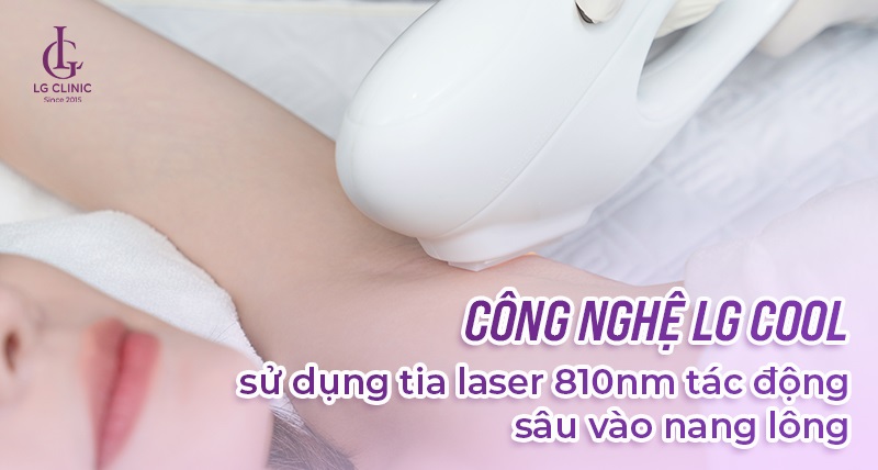 Công nghệ LG Cool sử dụng tia laser tác động sâu vào các nang lông làm chúng suy yếu